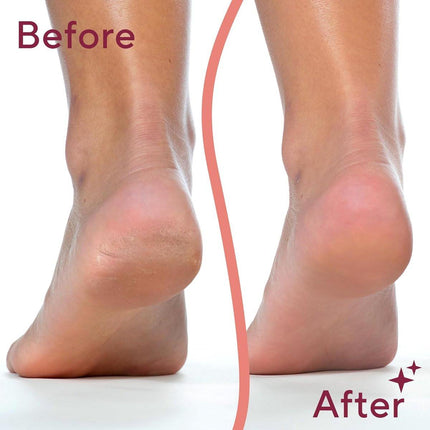 Foot Repair - Rechargeable Electric Callus Remover - Removes Dry Skin - For Smoother Feet.