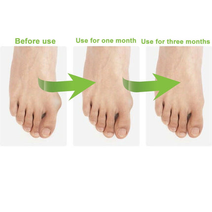 Onemayship Silicone Gel Toe Separator Orthotics Bunion Toes Spacer Pain Reliever 12Pcs.
