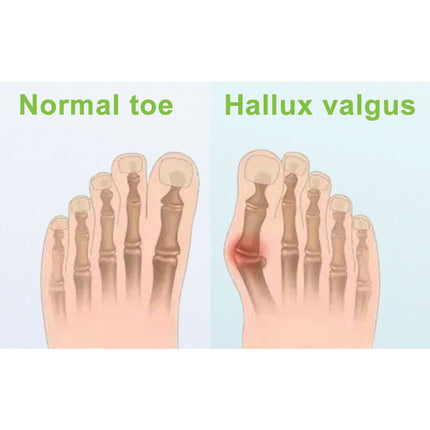 Onemayship Silicone Gel Toe Separator Orthotics Bunion Toes Spacer Pain Reliever 12Pcs.