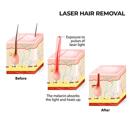 Silhouette Portable Laser Hair Remover Permanent Epliation System Body Face Home.
