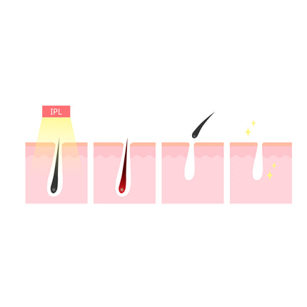 Silhouette Portable Laser Hair Remover Permanent Epliation System Body Face Home.
