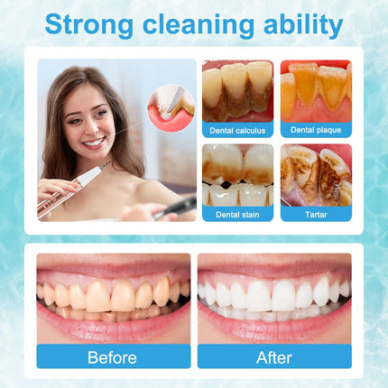 Ultrasonic Dental Scaler Kit - Home Use Teeth Cleaner & Tartar Remover.