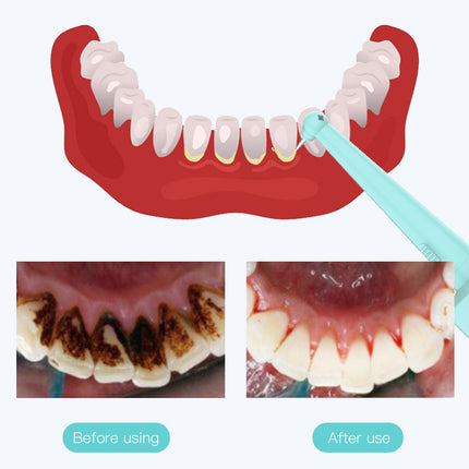 Intelligent High-Frequency Vibration Dental Calculus & Stain Remover(blue).