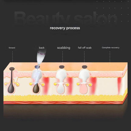 Professional Electric Mole & Dark Spot Remover Pen - Advanced Plasma Ion Technology for Seamless Skin Tag & Freckle Removal (Purple).